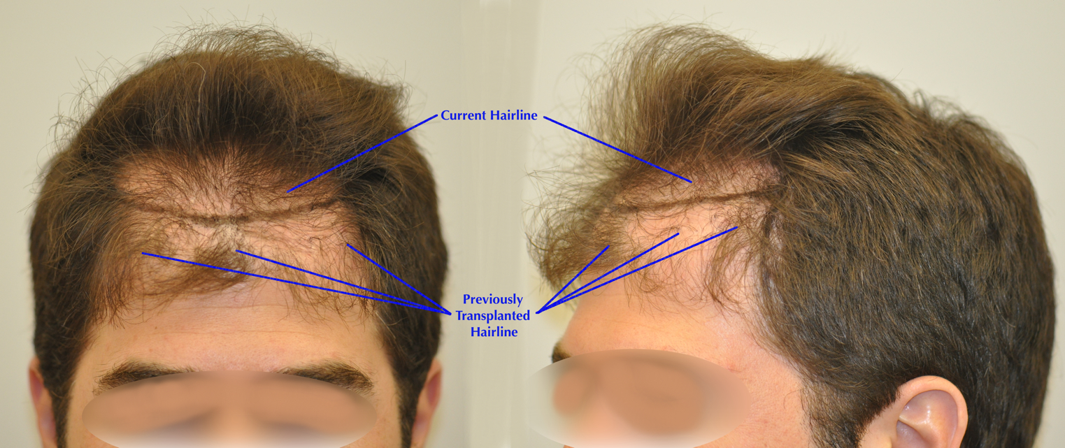 Unnatural%20Low%20Hairline%20Tranpslant.jpg