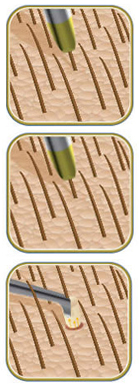 Transplante Capilar, Perda De Cabelo,Nova Iorque,