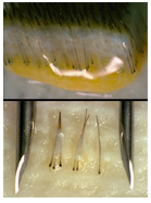 P�rdida De Pelo, 
p�rdida De Cabello, 
Transplante De Cabello, 
