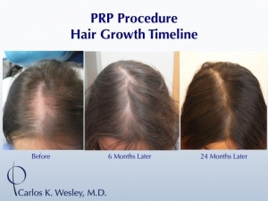 Dermatology Grand Rounds: Dr. Wesley Featured Lecturing on PRP for Hair Loss  | Dr. Carlos Wesley